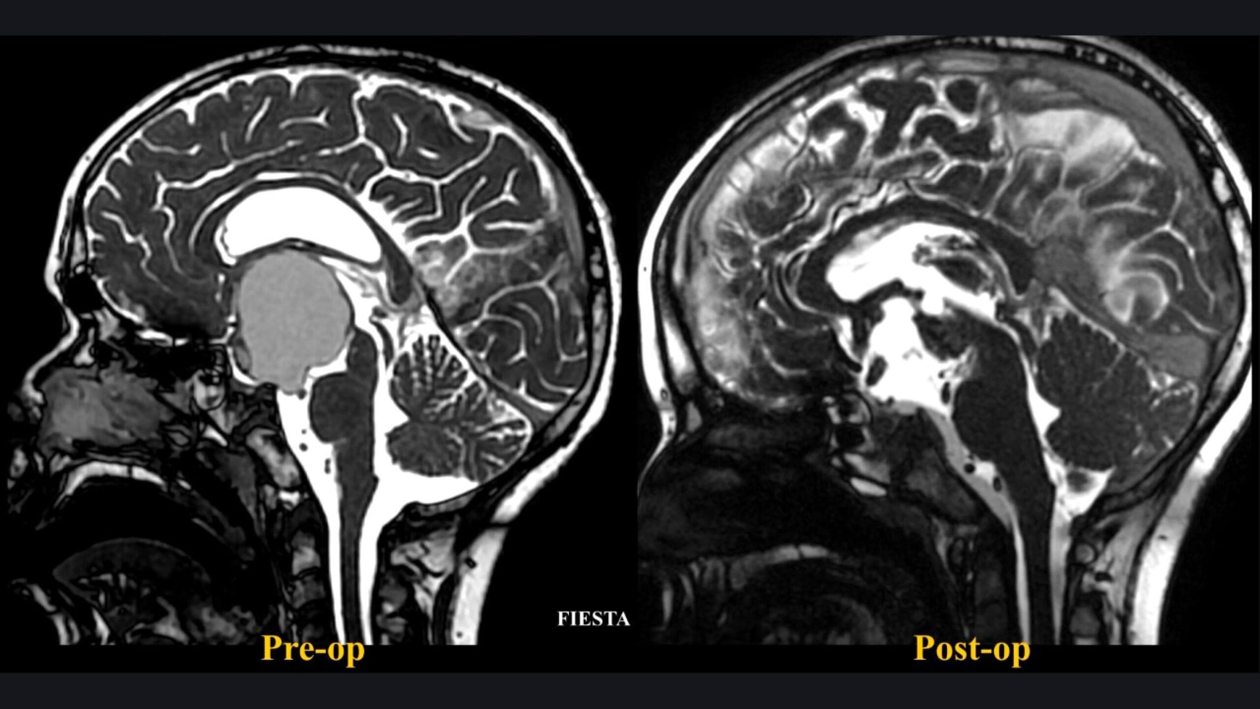 El Dr. Luis Borba realiza la resección microquirúrgica de un craneofaringioma retroquiasmático mediante abordaje petroso posterior modificado