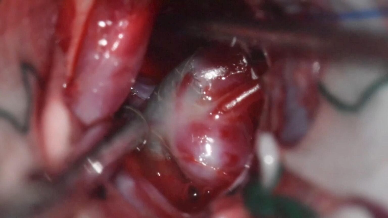 Clipaje transcavernoso aneurisma