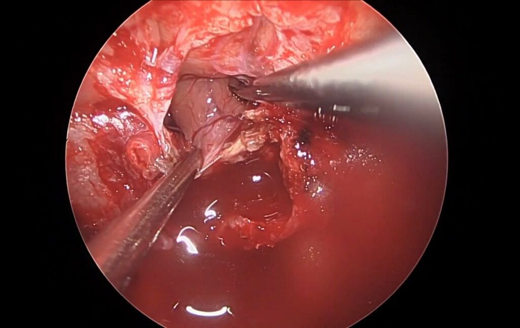Macroadenoma hipofisario supraselar