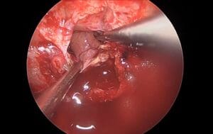 Macroadenoma hipofisario supraselar