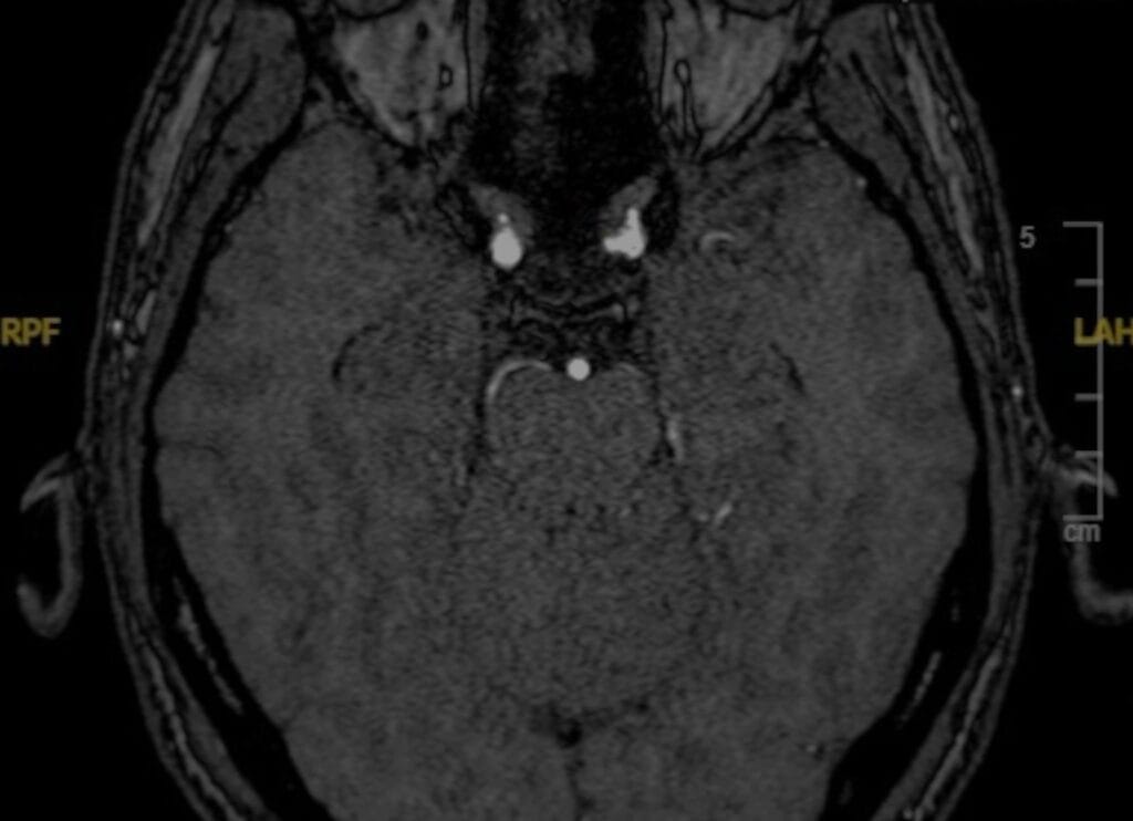 Clinoidectomía intradural