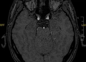 Clinoidectomía intradural