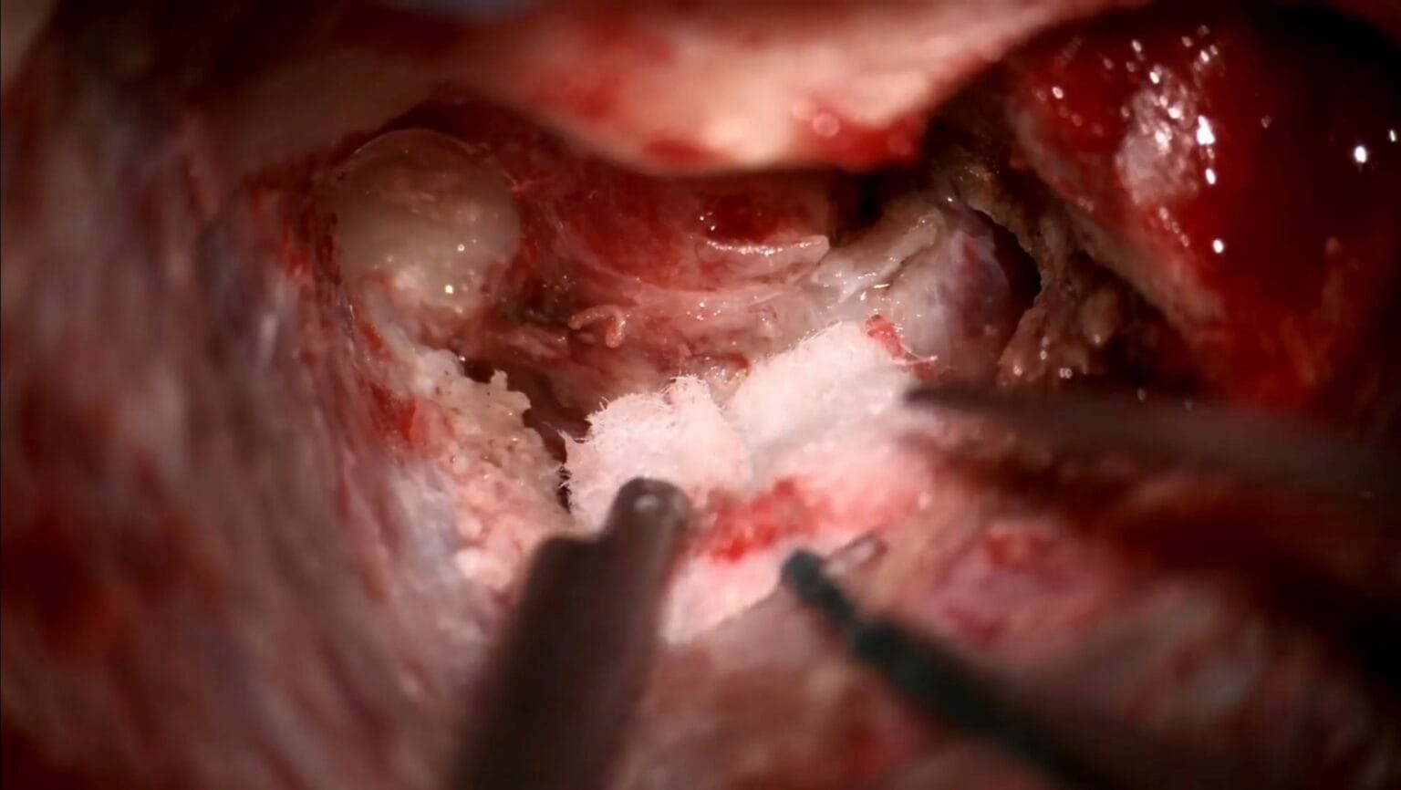 Neurinoma del acústico