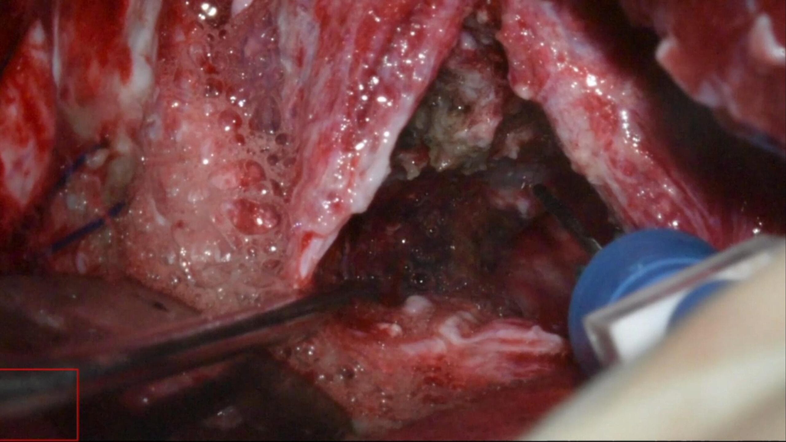 Cavernous sinus giant chondrosarcoma