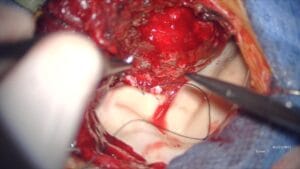 Metástasis esfenoorbitaria