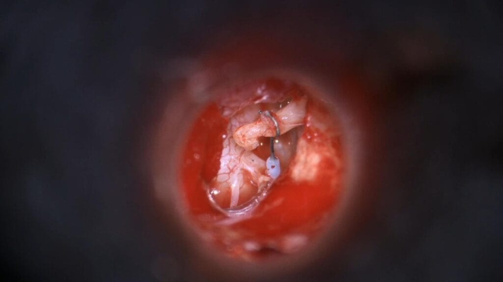 Revision stapedectomy with cartilage