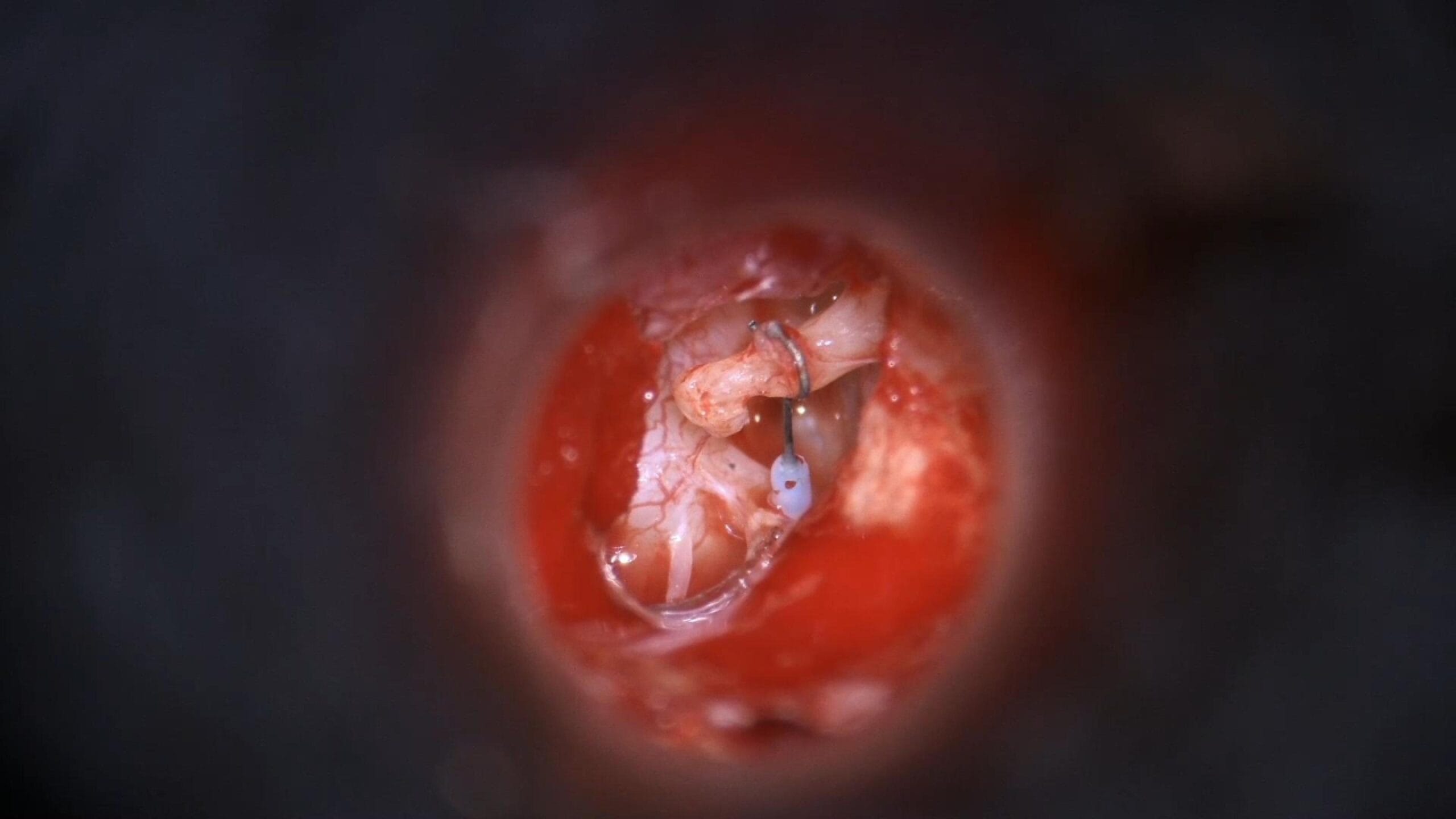 Revision stapedectomy with cartilage