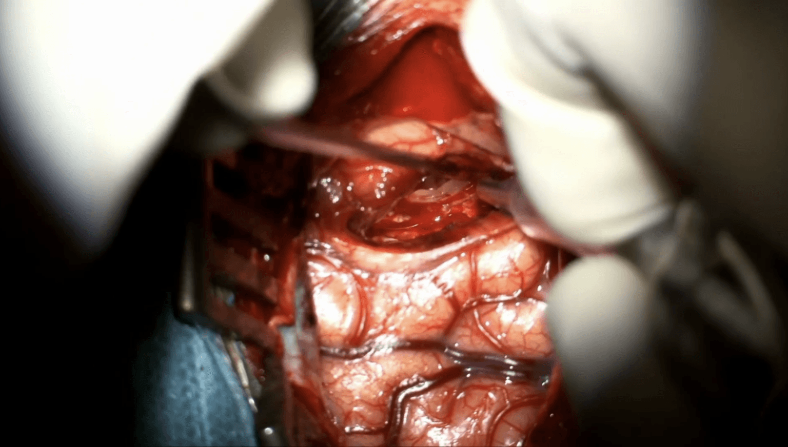 Amigdalohipocampectomía selectiva transcortical