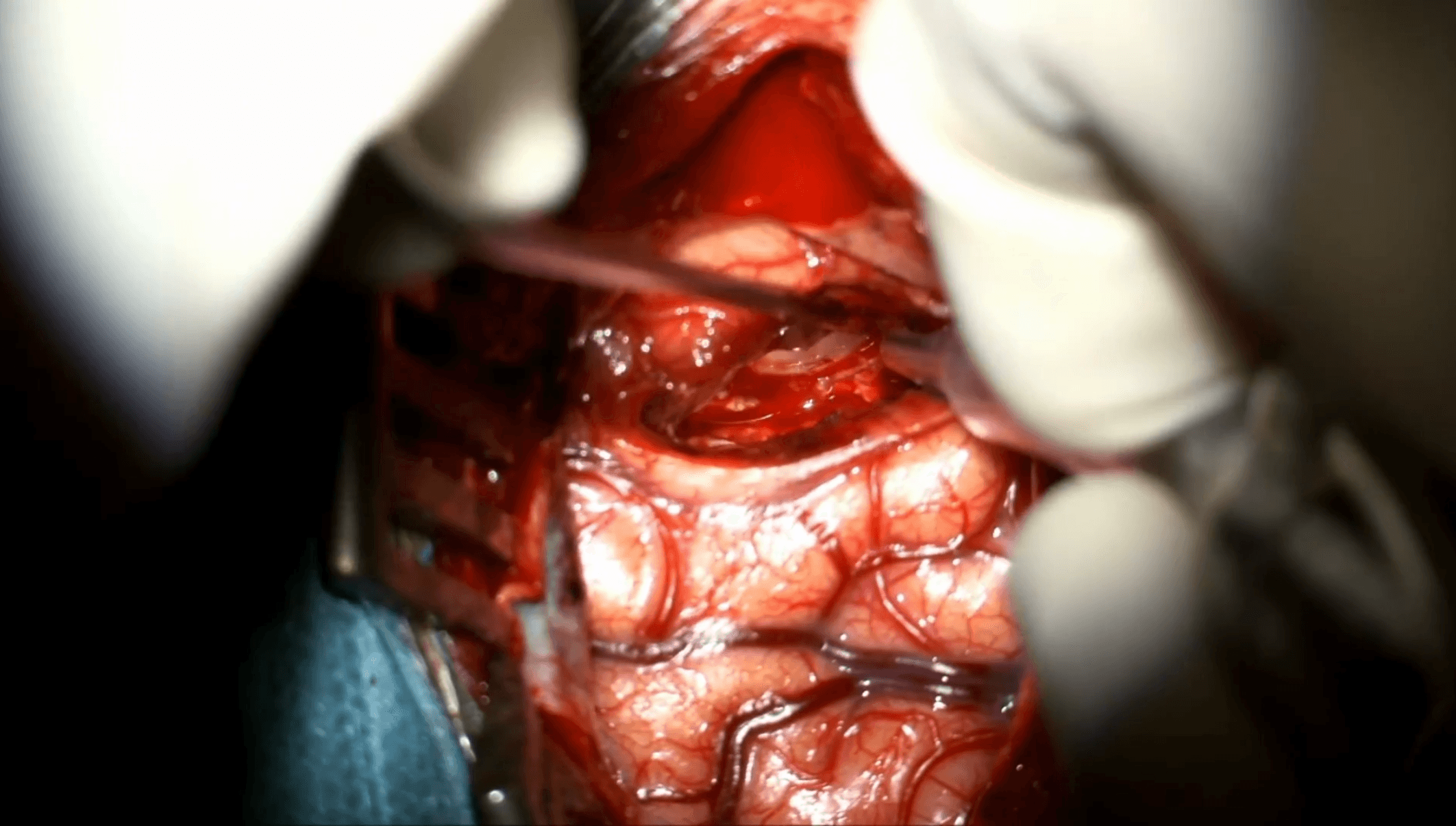 Amigdalohipocampectomía selectiva transcortical