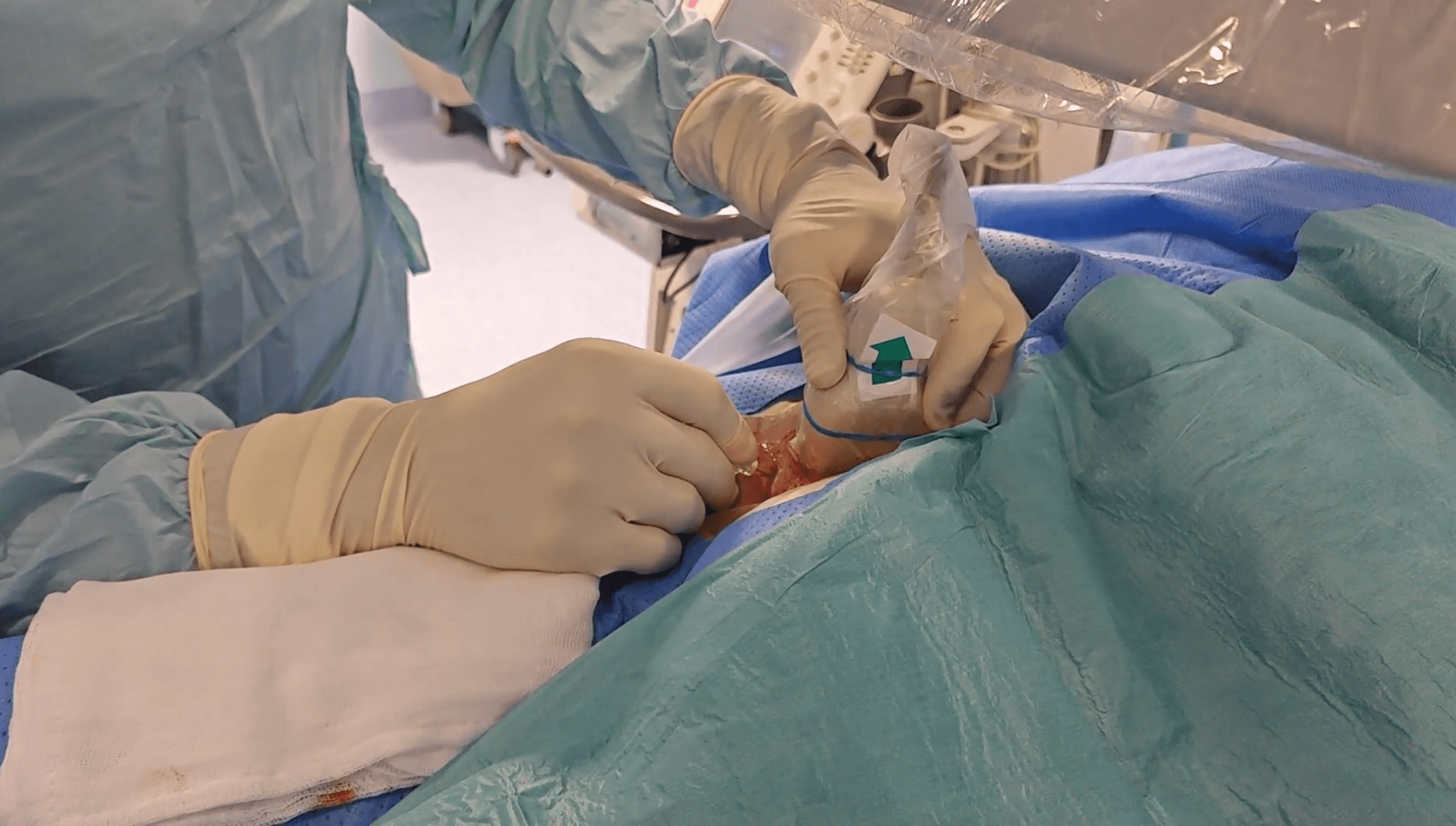 embolización arterias bronquiales