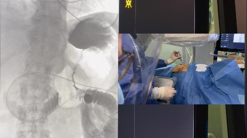 Gastrostomía a gastroyeyunostomía percutánea.