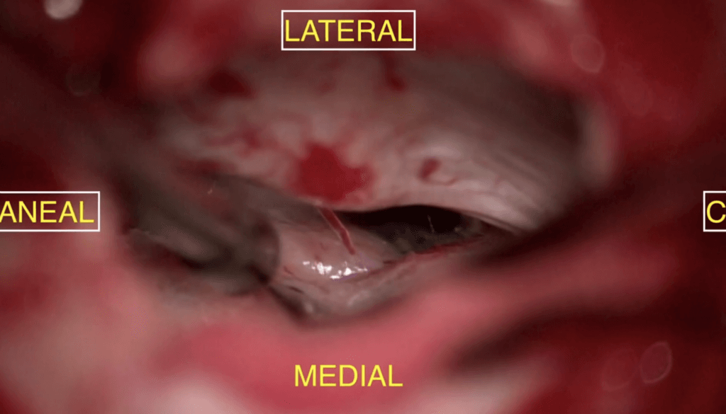 Espasmo Hemifacial