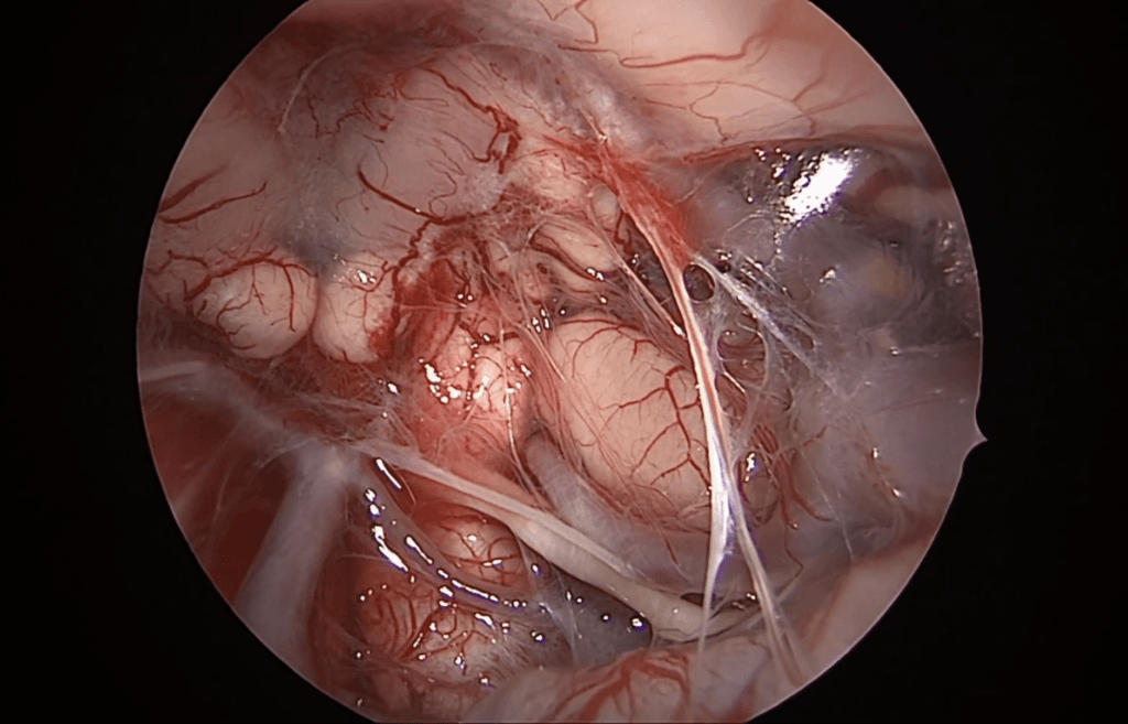 Cordosarcoma atípico