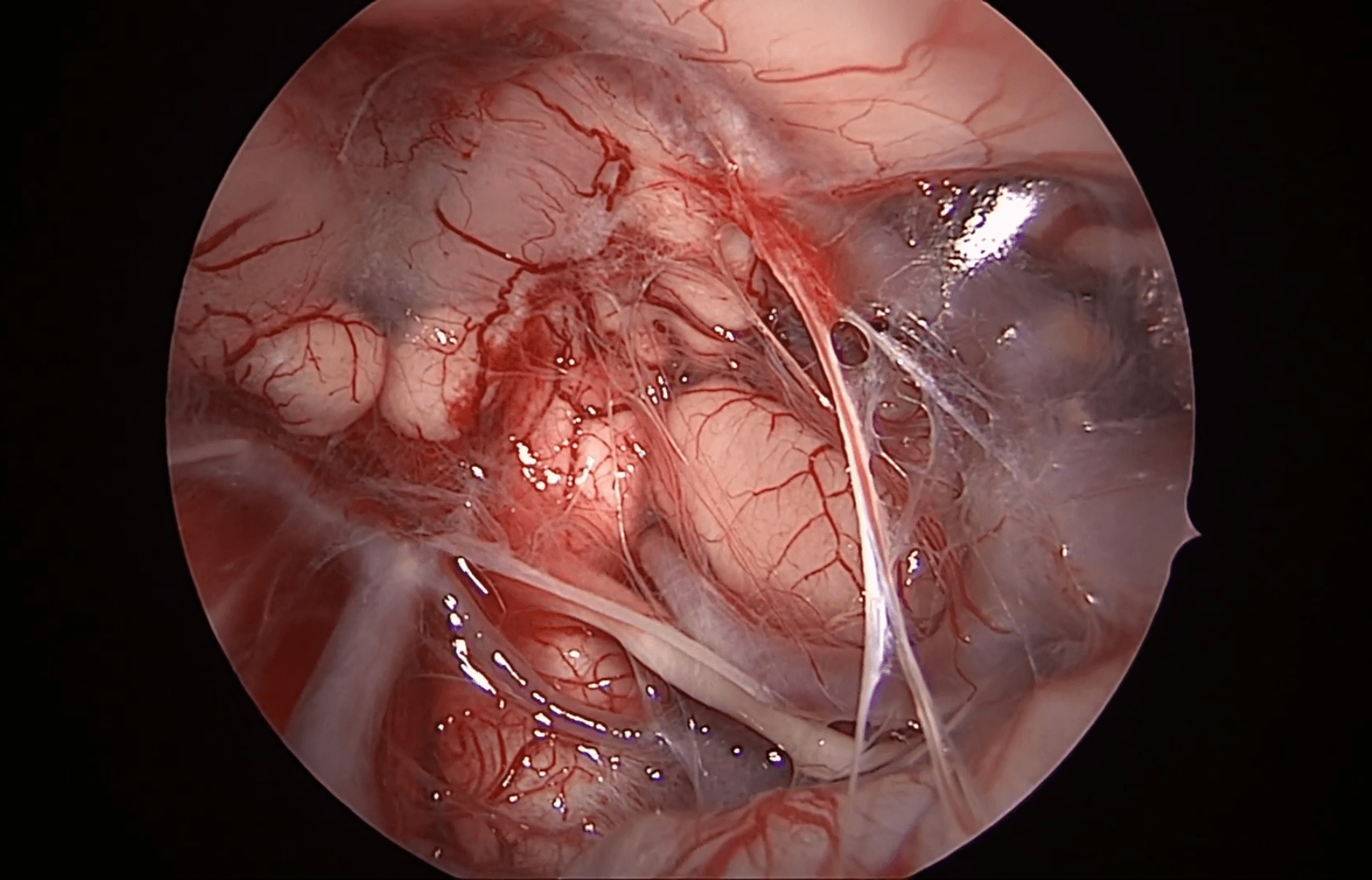 Cordosarcoma atípico