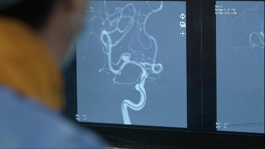 Embolización de aneurisma cerebral con dispositivo intrasacular Artisse