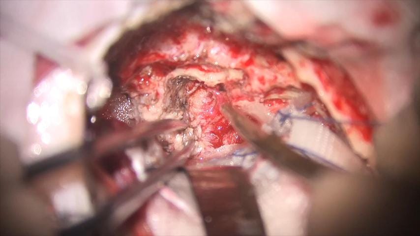 Meningioma esfenopetroclival