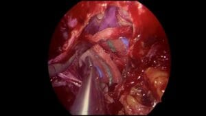 Cordoma craneocervical