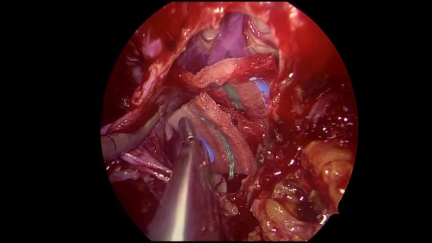 Cordoma craneocervical