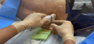 Punción lumbar ecoguiada ONLYTRANS