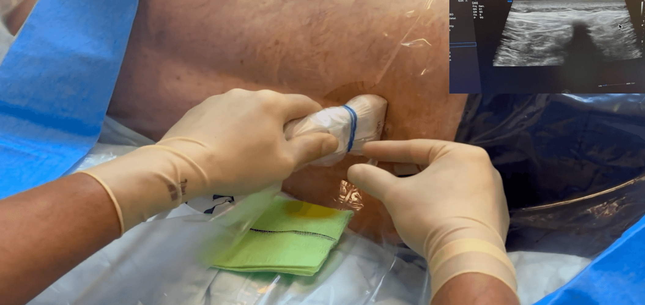 Punción lumbar ecoguiada ONLYTRANS