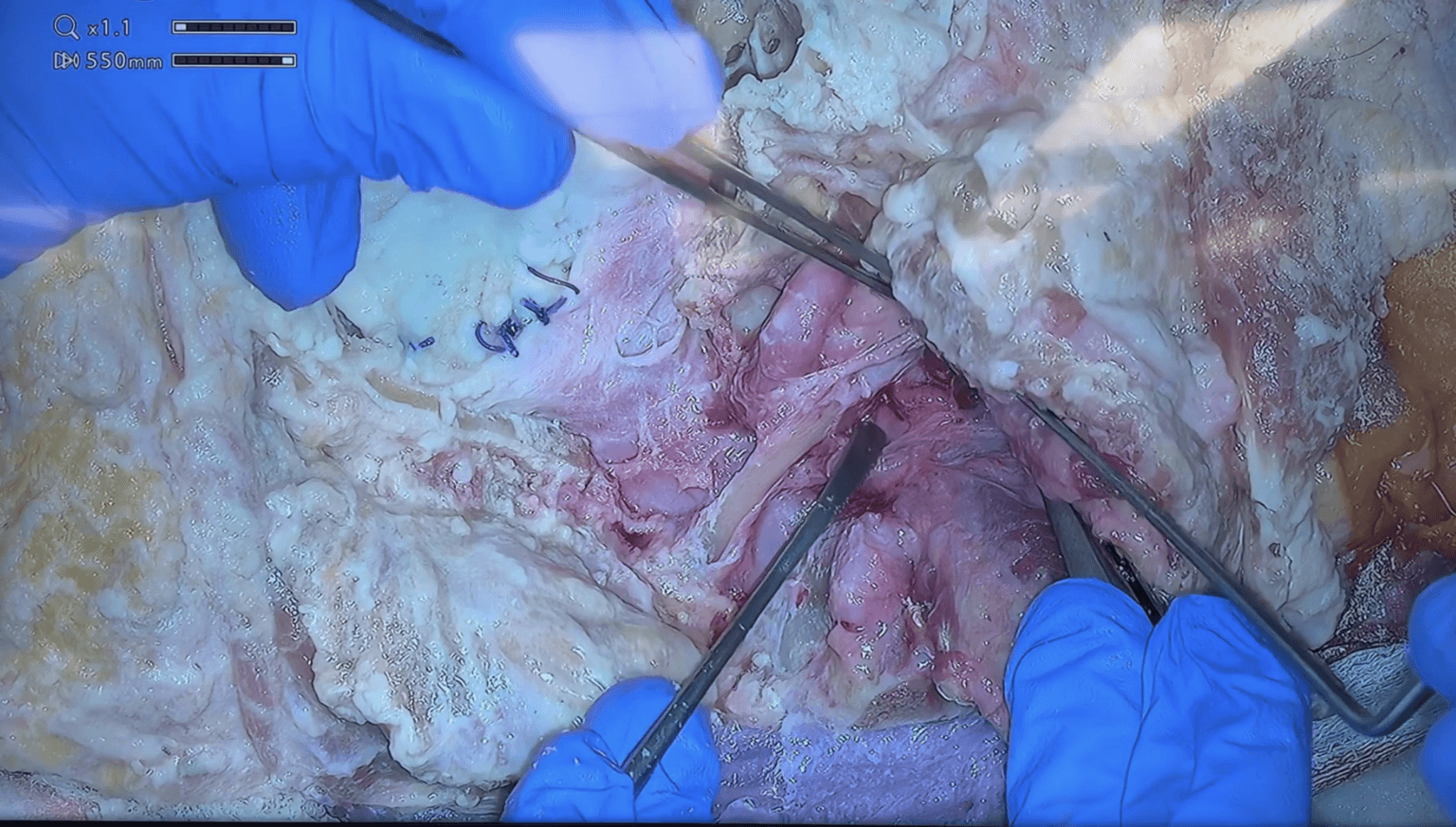 Abordaje transcondilar