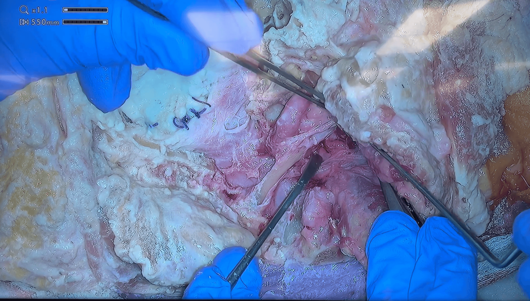 Abordaje transcondilar