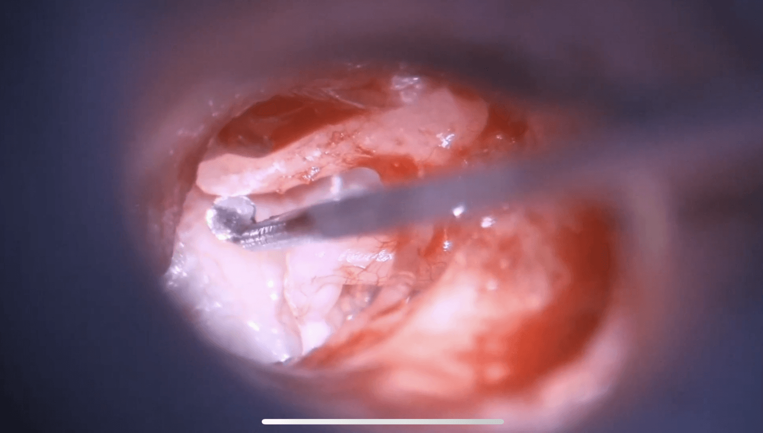 Fijación del martillo