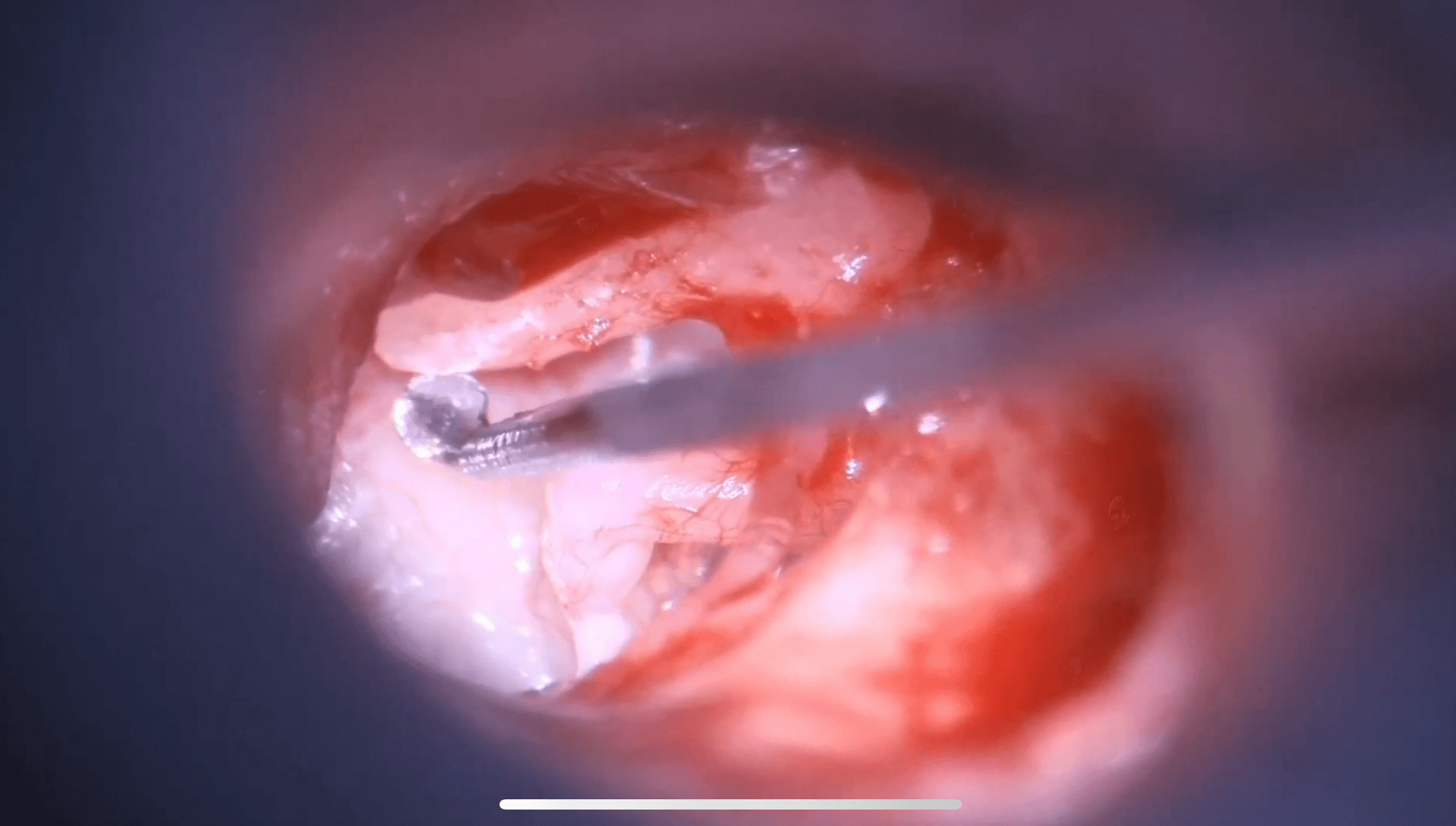 Fijación del martillo