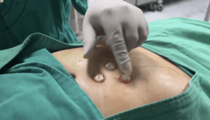 Gastrostomía percutánea guiada por imagen