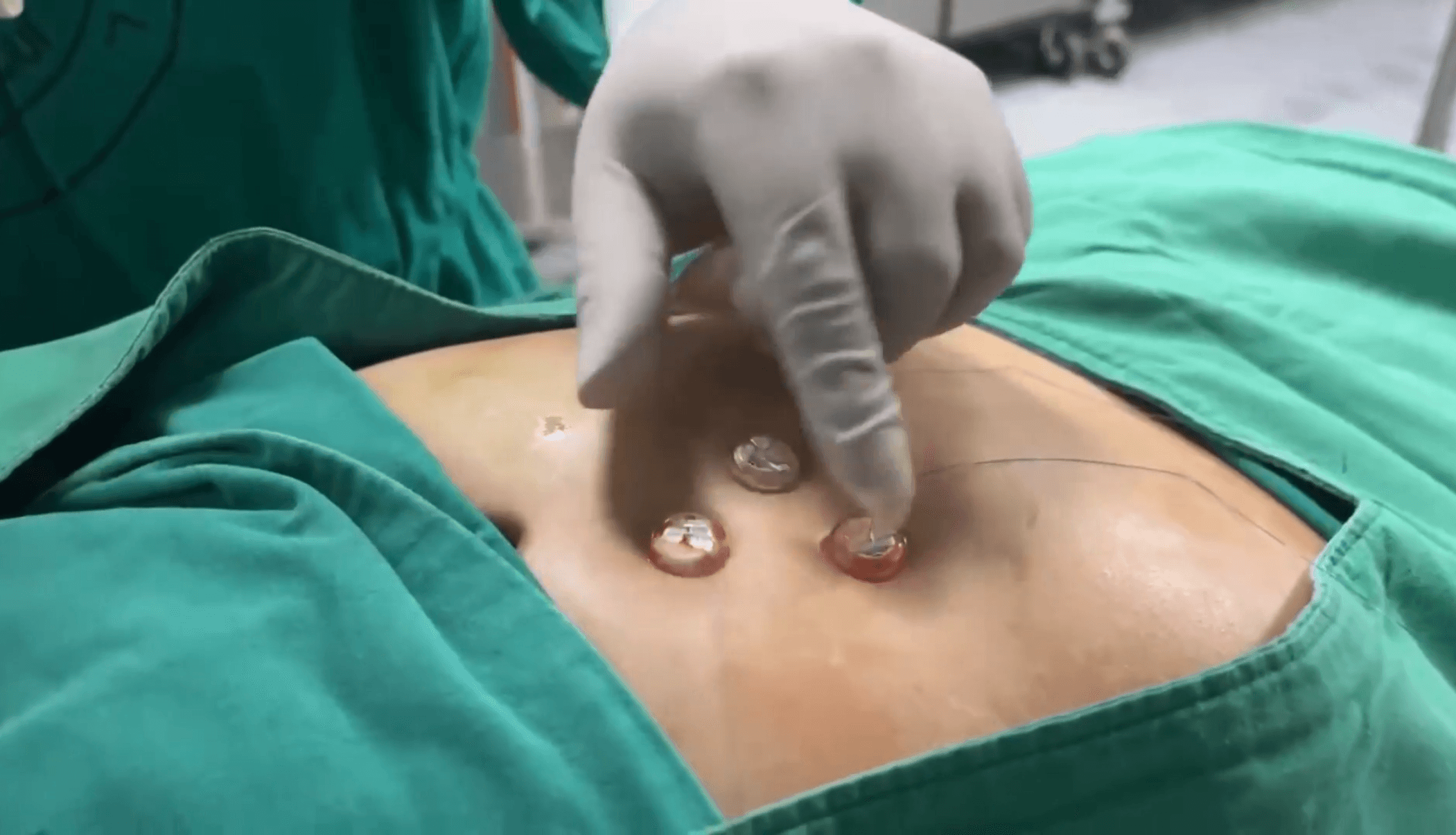 Gastrostomía percutánea guiada por imagen