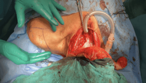 El Dr. Ferrandis realiza faringolaringuectomía total circular subtotal de rescate con resección oncológica amplia y reconstrucción faríngea.