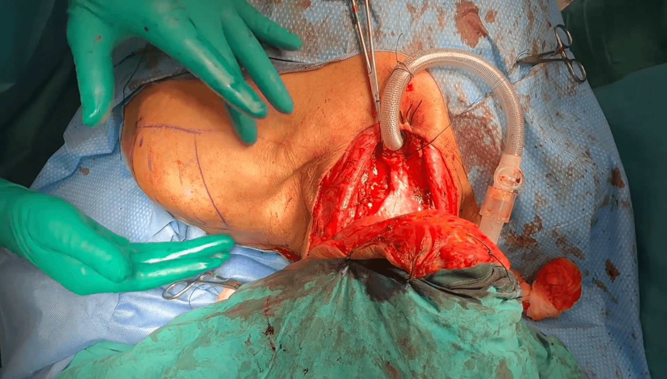 El Dr. Ferrandis realiza faringolaringuectomía total circular subtotal de rescate con resección oncológica amplia y reconstrucción faríngea.