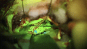 Schwannoma vestibular Koos III