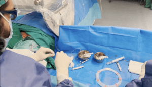 Embolización de varices pélvicas