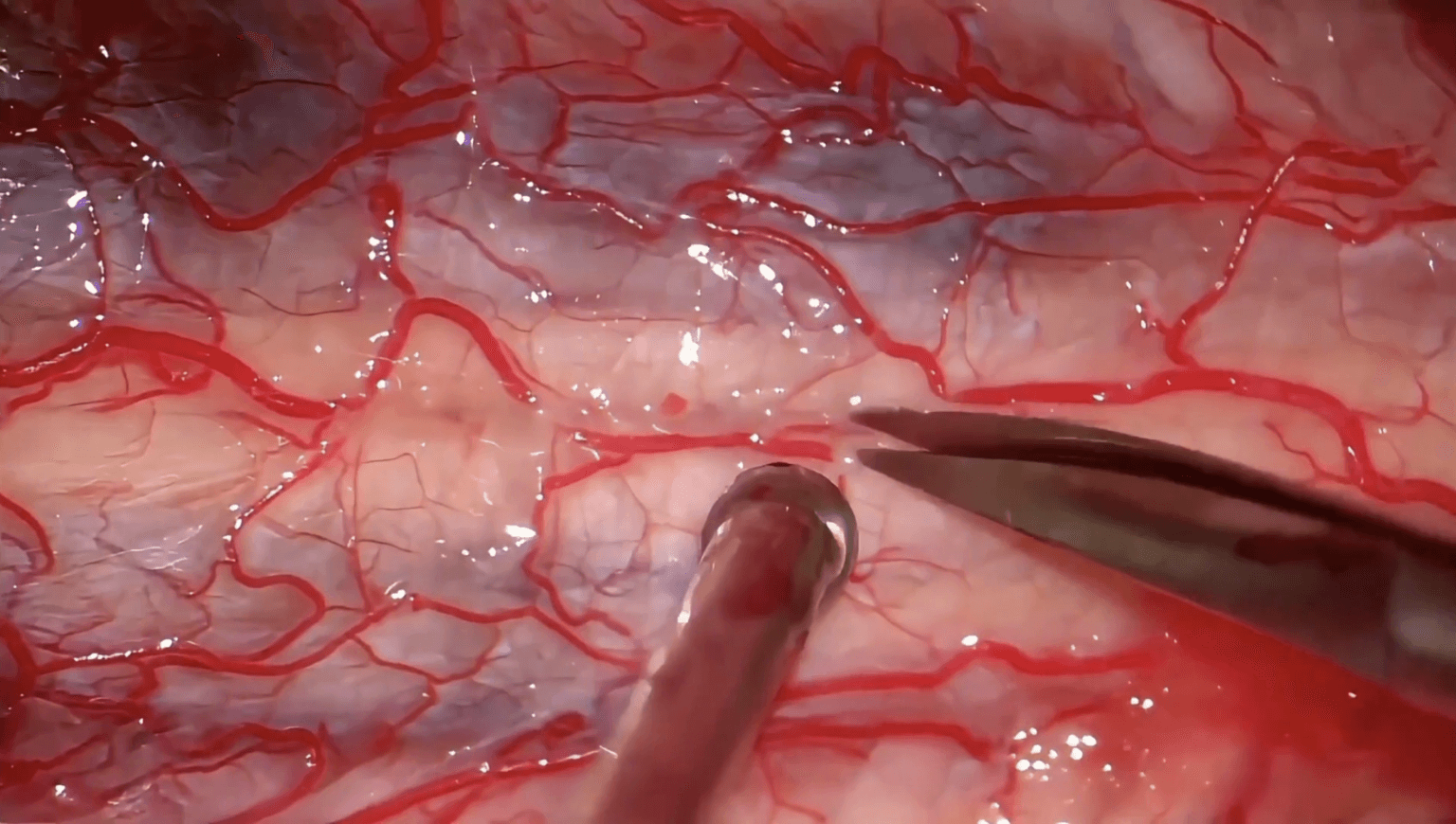 ependimoma cervical