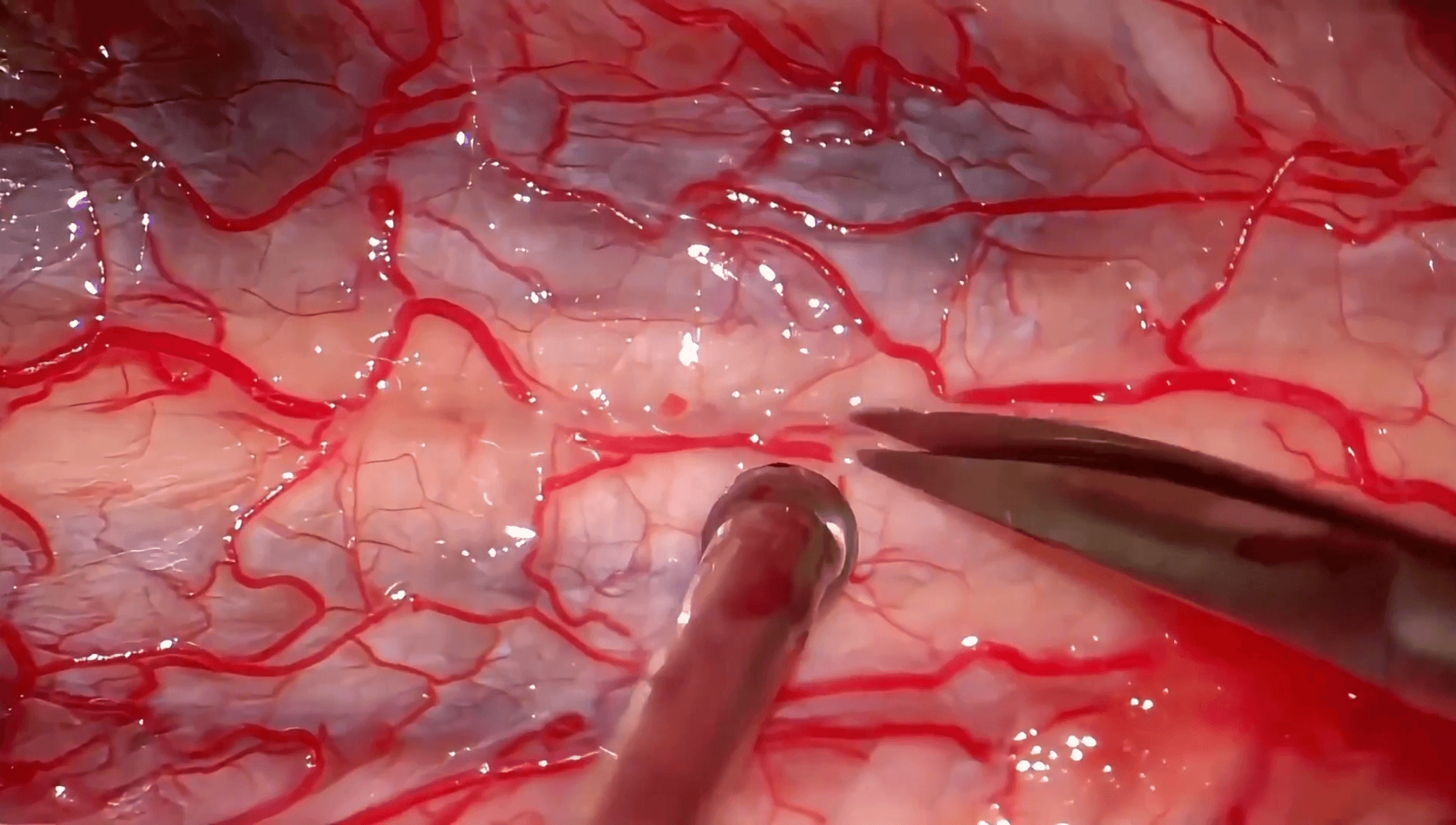 ependimoma cervical