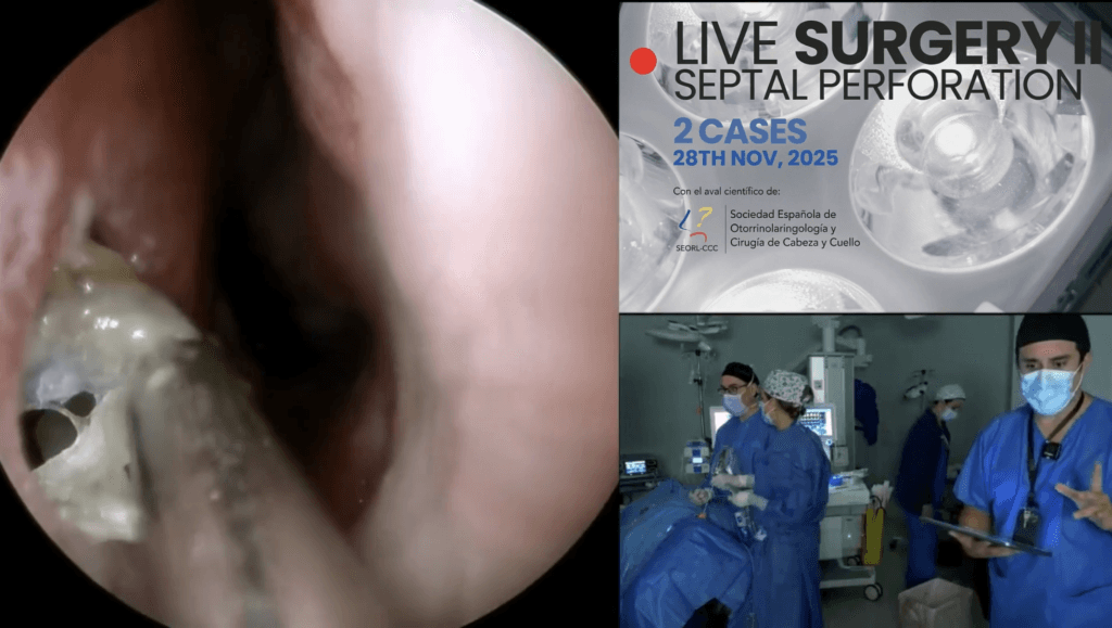 Perforación septal