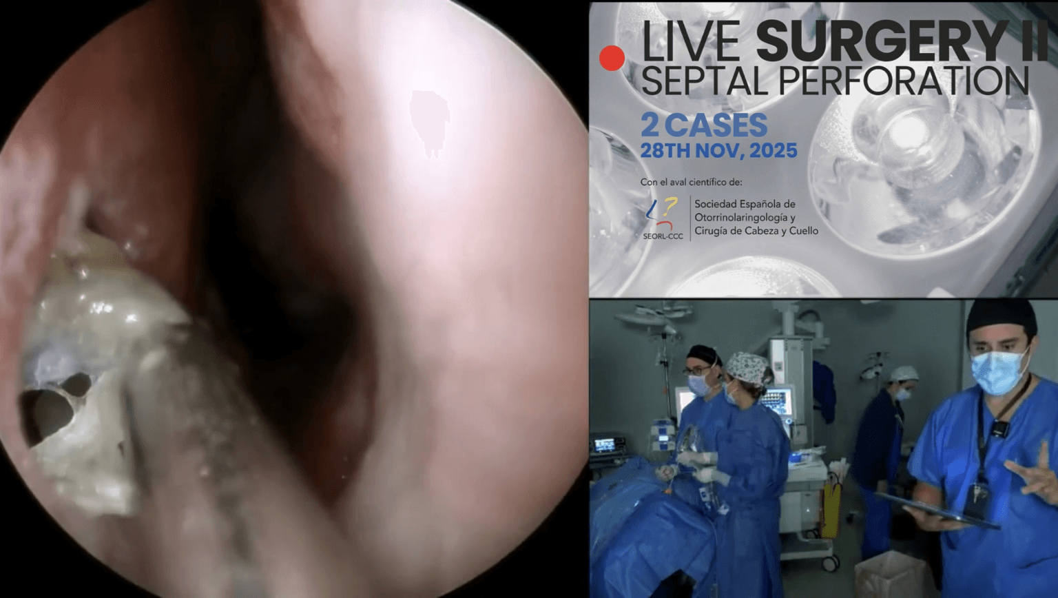Perforación septal