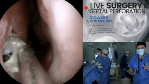 Perforación septal