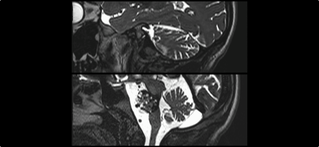 Cavernoma gigante del tronco encefálico.