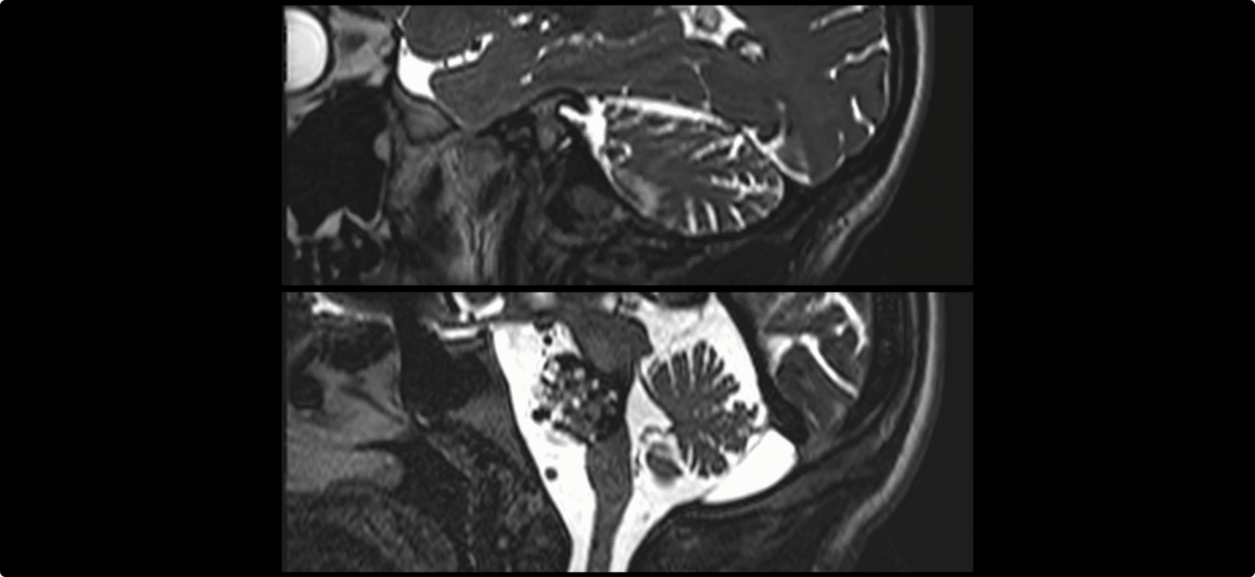Cavernoma gigante del tronco encefálico.