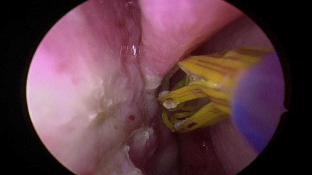 ablación nervio nasal posterior