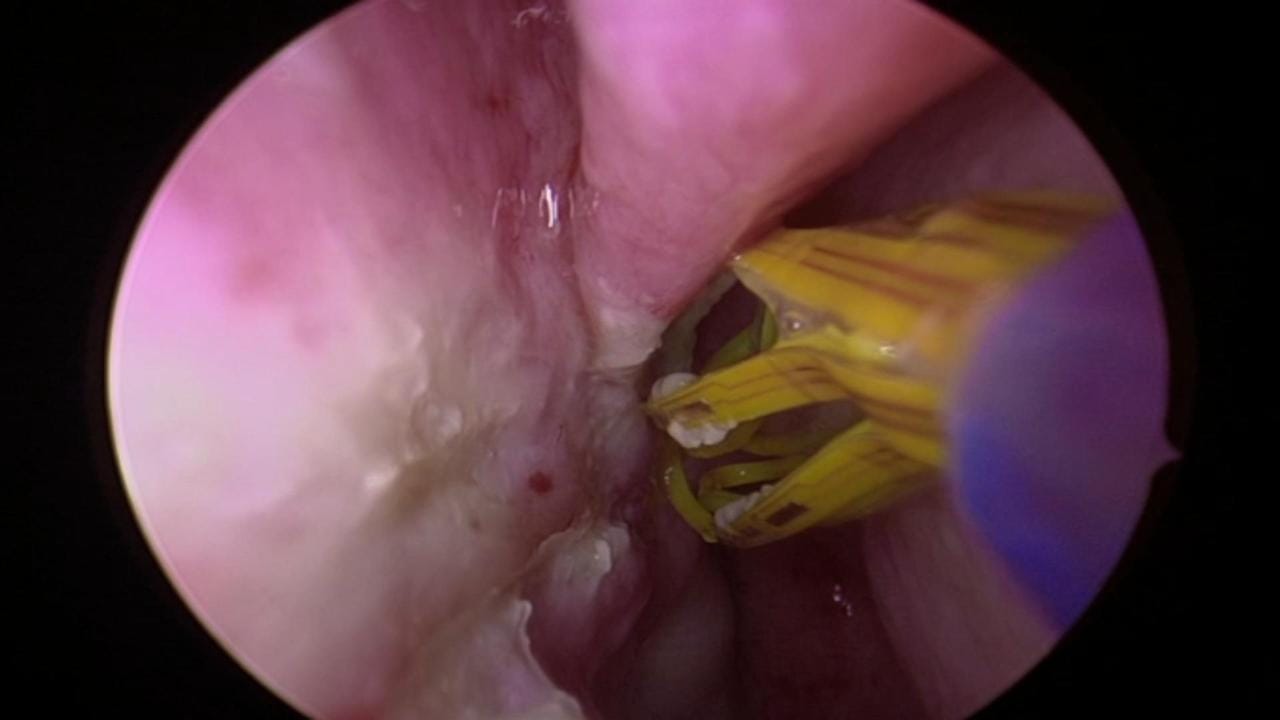 ablación nervio nasal posterior