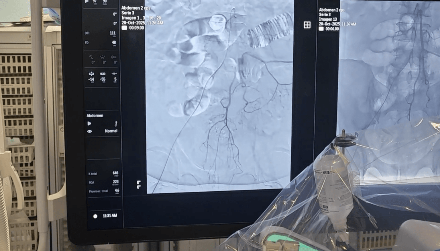 embolización de arterias hemorroidales superiores