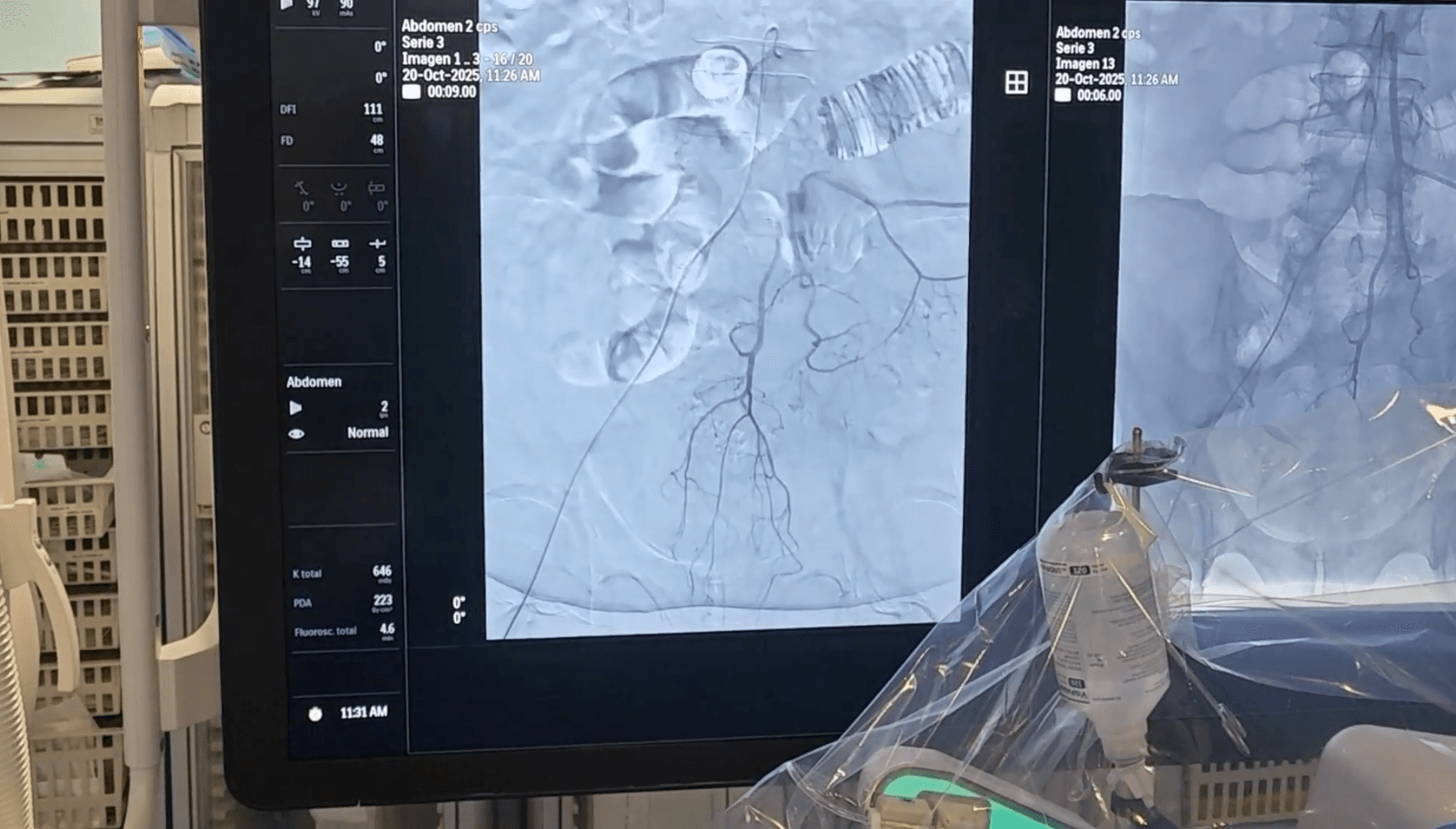 embolización de arterias hemorroidales superiores