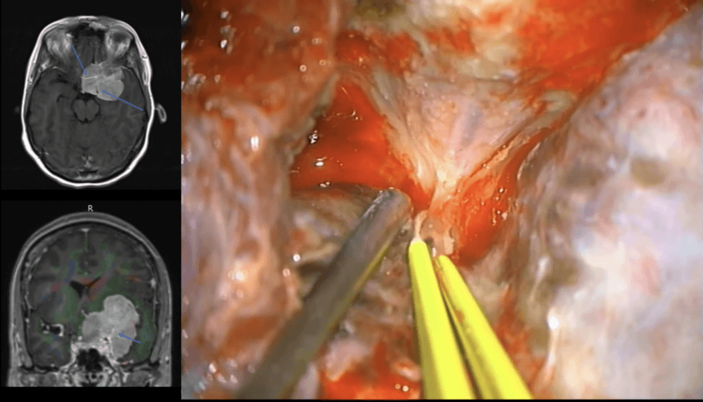 Unwrapping meningiomas paraselares