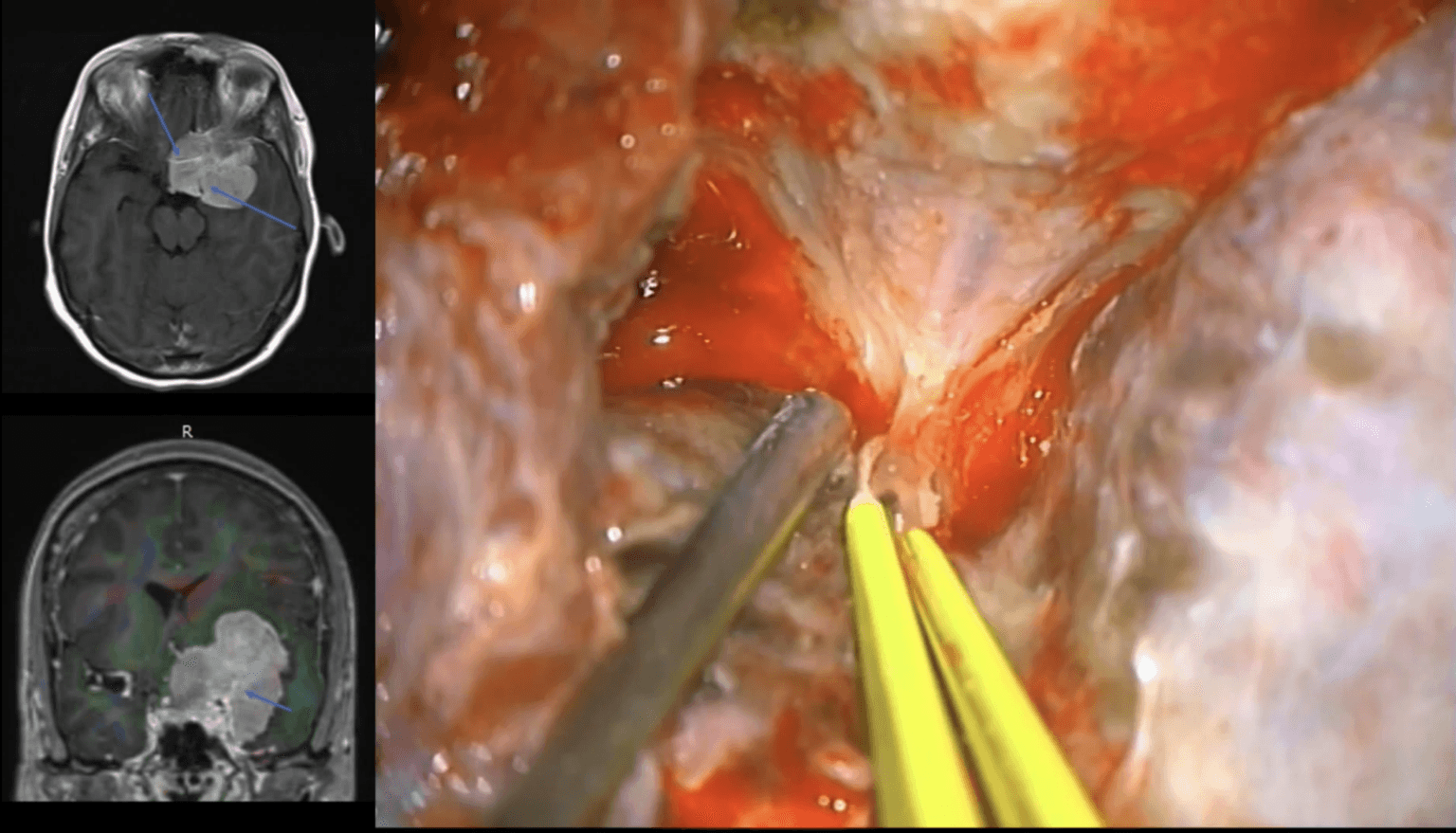 Unwrapping meningiomas paraselares