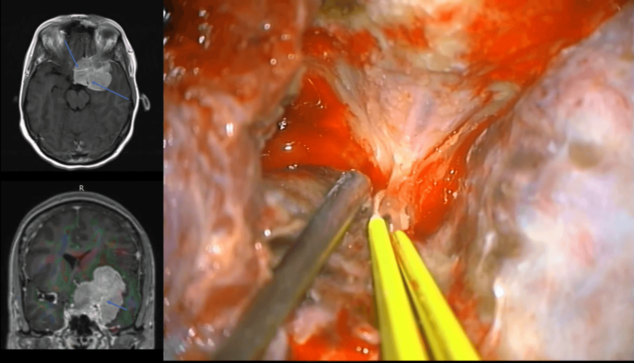 Unwrapping meningiomas paraselares