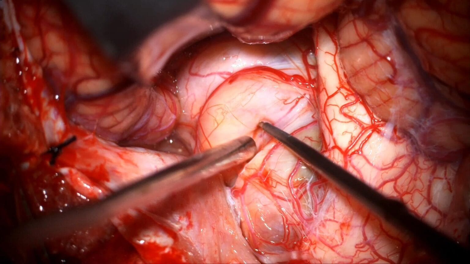 Schwannoma hipogloso gigante