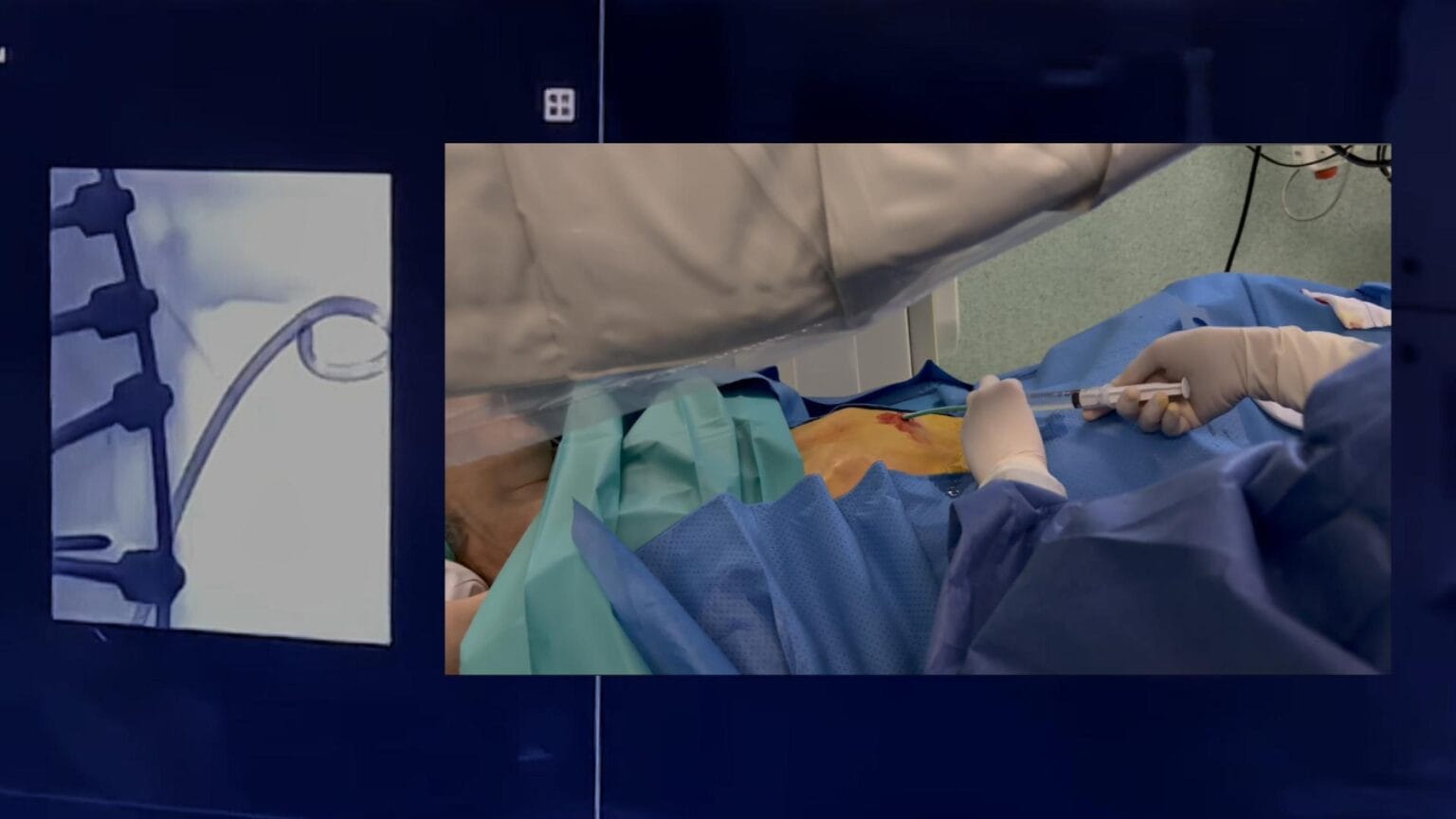 Gastrostomía percutánea por disfagia